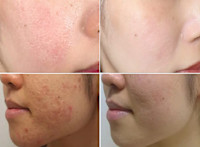 美療顔脱毛＋4種類の特許フェイシャル（肌荒れ）(ハダアレ)