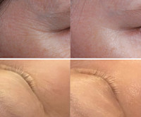 美療顔脱毛＋4種類の特許フェイシャル（シワ）(シワ)