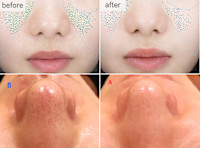 IPL光美容（光フォト）＋4種類の特許フェイシャル（毛穴）(ケアナ)