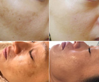 肝斑トーニング(カンパン)