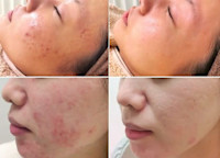 IPL光美容（光フォト）＋4種類の特許フェイシャル（ニキビ）(ニキビ)