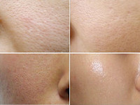 IPLカーボン（毛穴）(ケアナ)