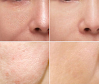 YAGカーボン（毛穴）(ケアナ)