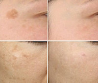 IPL光美容＋4種類の特許フェイシャル（シミ剥離コース）(シミ)