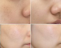 IPL光美容＋4種類の特許フェイシャル（シミ徐々に薄く）(シミ)