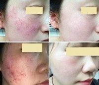 ニキビ専門ケア「プラズマ」(ニキビ)