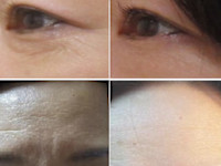 IPL光美容（光フォト）＋4種類の特許フェイシャル（シワ）(シワ)