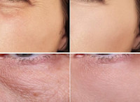 シワ専門ケア「プラズマ」(シワ)