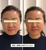 ウルトラリフト(ウルトラリフト)