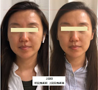 ウルトラリフト(ウルトラリフト)