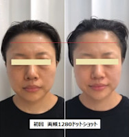 ウルトラリフト(ウルトラリフト)