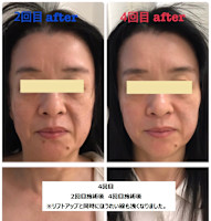 ウルトラリフト(ウルトラリフト)