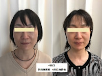 ウルトラリフト(ウルトラリフト)