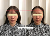 ウルトラリフト(ウルトラリフト)