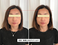 ウルトラリフト(ウルトラリフト)