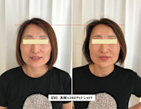 ウルトラリフト(ウルトラリフト)