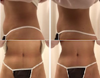 オンダリフトボディ【痩身】(オンダリフトボディ)