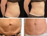 オンダリフトボディ【痩身】(オンダリフトボディ)