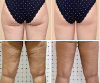 オンダリフトボディ【痩身】(オンダリフトボディ)