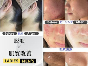 【ハーブピーリング|肌質改善】BE:SKIN広島(ハーブピーリング ハダシツカイゼン ビー スキンヒロシマ)