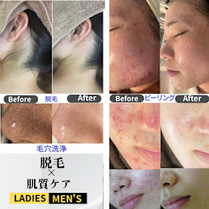 【ハーブピーリング|肌質改善】BE:SKIN広島(ハーブピーリング ハダシツカイゼン ビー スキンヒロシマ)