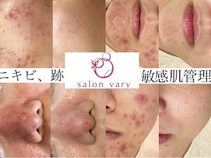 肌質改善水玉リフティング＆ハーブピーリングsalonvary(ハダカイゼンミズタマリフティングハーブピーリングヴェアリー)