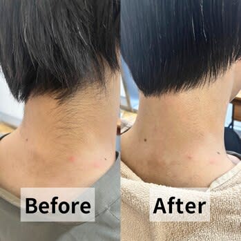 メンズうなじ脱毛