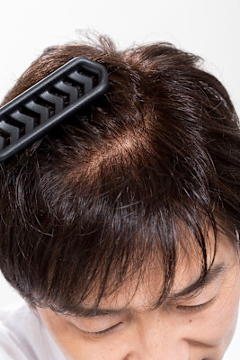 かつらセカンドオピニオン相談