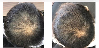 ニコヘアーオリジナル育毛メニュー