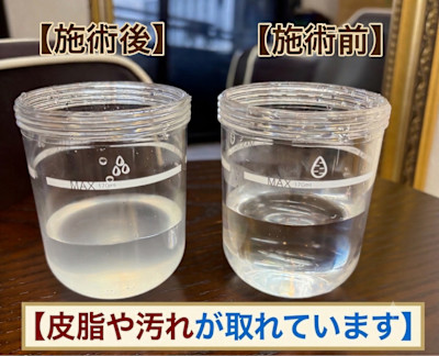 An Livianでの頭皮環境改善ででた皮脂