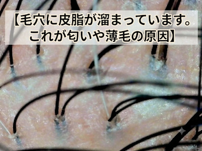 頭皮に皮脂があり、赤みなどの炎症もある頭皮写真　よくないです