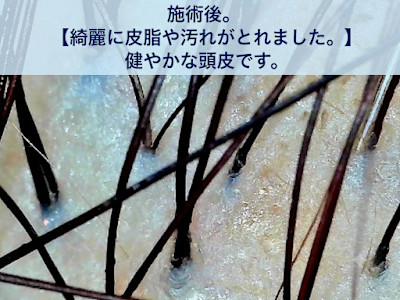 正常な美しい頭皮の写真です