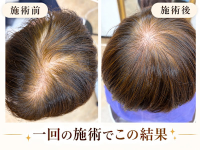 頭皮ケア施術1回でこの結果です