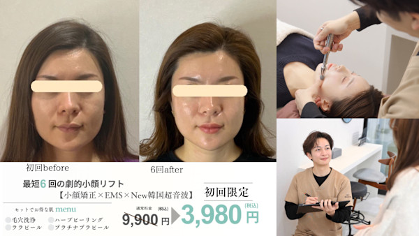 小顔・肌質改善サロンespoir ハーブピーリング/毛穴(コガオハダシツカイゼンサロンエスポワールハーブピーリングケアナ)