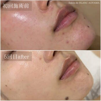 【肌質改善】Salon de BLANC クリスティーナ/ハーブピーリング/毛穴/小顔/痩身(ハダシツカイゼン サロンドブラン)