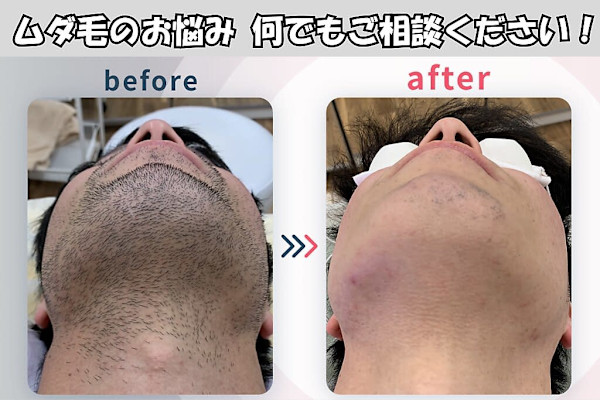 メンズ脱毛NEXT+梅田店(メンズダツモウネクストプラスウメダテン)