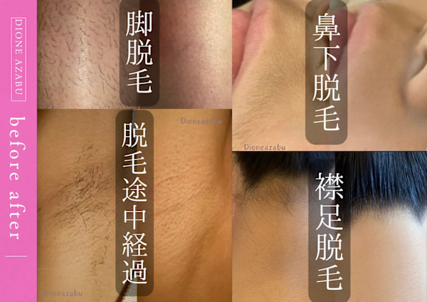 美肌脱毛専門サロン Dione 麻布十番店(ビハダダツモウセンモンサロンディオーネアザブジュウバンテン)