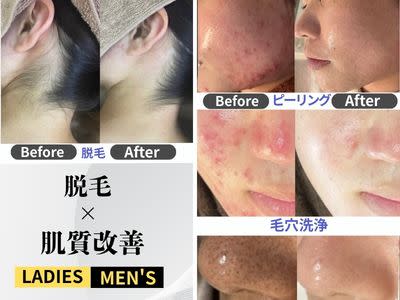 【ハーブピーリング|肌質改善】BE:SKIN広島(ハーブピーリング ハダシツカイゼン ビー スキンヒロシマ)