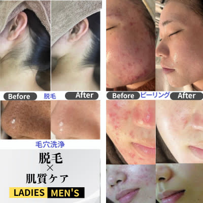 【ハーブピーリング|肌質改善】BE:SKIN広島(ハーブピーリング ハダシツカイゼン ビー スキンヒロシマ)