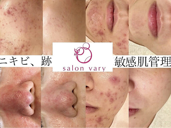 肌質改善水玉リフティング＆ハーブピーリングsalonvary(ハダカイゼンミズタマリフティングハーブピーリングヴェアリー)