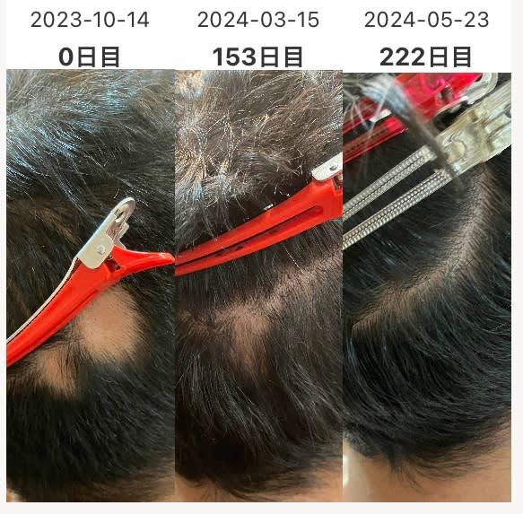 hair studio 102【ヘアスタジオイチマルニ】のスタイル紹介。円形脱毛症の改善