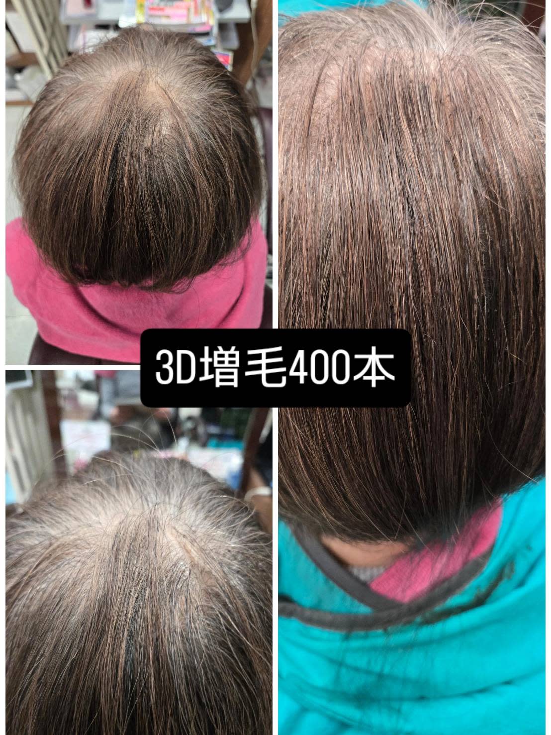 OZ【オズ】のスタイル紹介。{毛量アップ】つむじ隠し３D増毛エクステ